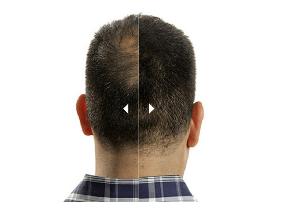 A man with half his scalp showing bald spot while the other half is full of thick hair thanks to KeraFiber hair building fibers. Concept of hair fibers effectiveness, usage, benefits.